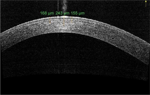 Figure 4 AS-OCT of keratoconus eye 6 months after epi-on corneal cross-linking radiating with UV-A at 3 mW/cm2.