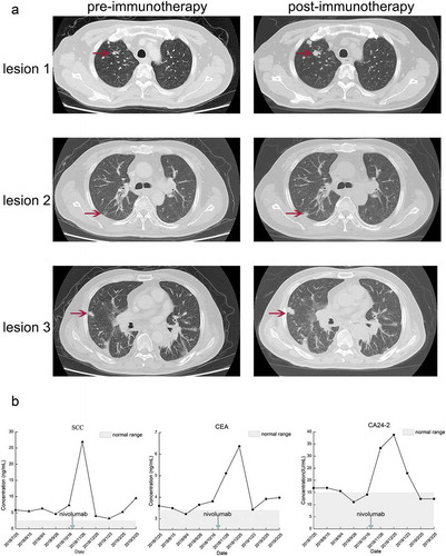 Figure 2. CT scan and tumor markers of the patient experienced HPD after nivolumab treatment. (a) The CT scan before and after nivolumab treatment. In this case, HPD was defined as a disease condition after anti-PD1/PD-L1 treatment which has a short TTF (less than 1 month) and a more than 50% increase than baseline in the size of the lesion. (b) The alterations in tumor markers during nivolumab treatment