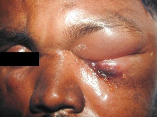 Figure 1 Brawny nonpitting edema of the upper and lower eyelids of the left eye with serosanguinous discharge