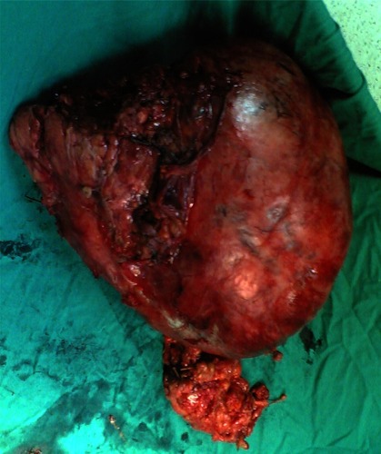 Figure 2 The posterior aspect of a GIST presenting as a huge abdominal mass attached to the left half of transverse colon with its mesocolon, body and tail of pancreas, and a part of the small intestine removed from a 28-year-old female.