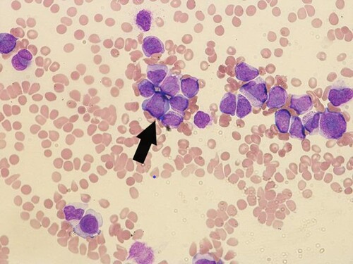 Figure 1. Peripheral blood showing abnormal promyelocytes with hyper granular cytoplasm with an arrow showing group of promylocytes