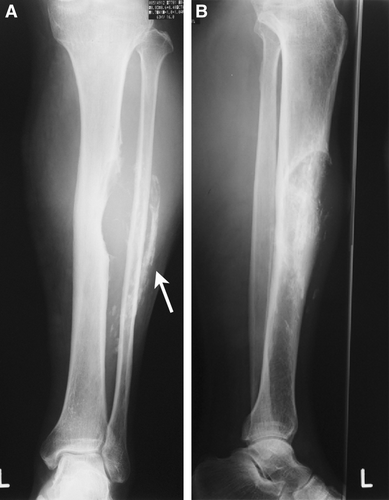 Figure 2.  Plain radiographs of the left leg revealed a soft tissue mass in the anterolateral part of the leg with extensive amorphous calcifications (arrow).