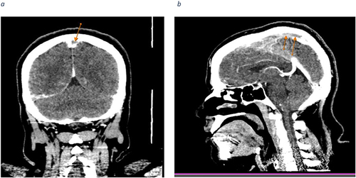 Figure 1 (a) Coronal contrast-enhanced CT scan of the brain reveals a filling defect along the superior sagittal sinus, presenting as a delta sign (indicated by an arrow). (b) Sagittal contrast-enhanced CT scan of the brain displays a tubular filling defect along the posterior aspect of the superior sagittal sinus (highlighted by an arrow).
