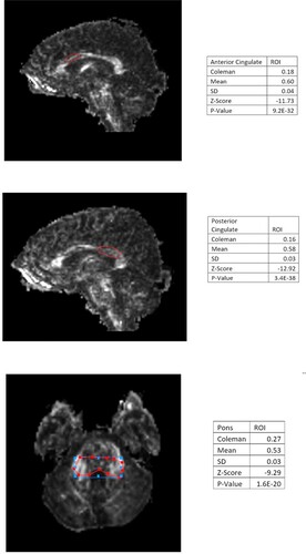 Figure 2. Quantitative Z-map statistical analysis of the defendant’s PET scan. Areas showing abnormal positive activation as compared to age and gender-matched controls are shown in black. The above z-map shows significant positive metabolic values in the cerebellum.