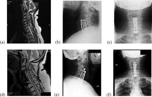 Figure 1. Clinical case: pre-operative MRI (a), post-operative lateral X-ray (b), post-operative AP X-ray (c), MRI 3-years after the operation (d), lateral X-ray after reoperation (e), AP X-ray after reoperation (f).