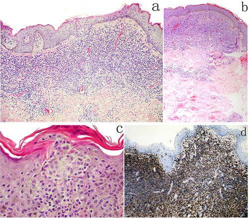 Figure 2 The biopsies from the papule (a) and the skin tag (b) show a dense, band-like lymphocytic infiltrate in the papillary and mid-reticular dermis. The super-basal epidermis contained both single and small collections of lymphoid cells (Pautrier’s collections) (c). Most of lymphoid cells are CD45RO-positive cells (d).