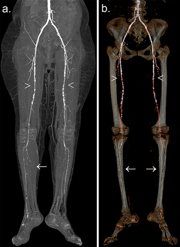 Figure 3 The pattern of PAD in a patient with diabetes. Maximal intensity projection image of lower limb CTA following contrast administration (a) with three-dimensional reformatted image over bony structures (b) demonstrates a moderate burden of atheromatous and atherosclerotic plaques causing multi-segmental stenoses predominantly at a proximal distribution of the lower extremity (arrowheads). However, below-knee vessels reveal a more extensive burden of PAD with segmental occlusions involving bilateral posterior tibial and peroneal arteries (arrows).