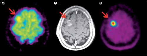 Figure 1. (A)18F-FDG; (B) contrast-enhanced MRI; (C) 11C-MET PET. Glioblastoma in the right frontal lobe, which is hard to delineate in the 18F-FDG PET. However, amino-acid PET with 11C-MET clearly shows the lesion with excellent tumor to background contrast.