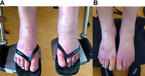 Figure 1 Chronic regional pain syndrome in the patient’s feet. (A) Before treatment. (B) After treatment with 10% ketamine cream and palmitoylethanolamide.