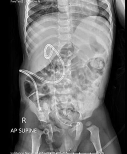 Figure 3 Post-operative plain X-ray with percutaneous nephrostomy and double J stent insertion.