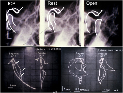 Figure 2. Radiographic images of the mandibular left TMJ at ICP before treatment (top-left), at rest position (top-middle), and at opening position (top-right). The condyle appeared to be displaced posteriorly at ICP and not traveled enough anteriorly at the jaw opening position. No baseline radiographs of the right TMJ are available, due to development failures. Baseline MKG recordings of habitual mandibular movement are shown (bottom). Dyskinesia (arrows) was observed during jaw opening in Scan 1 (bottom-left). The mandible moved anteriorly during closing, arrived at the mid-lingual surface of the maxillary incisor, and slid into ICP. The velocity of jaw movements was recorded and shown in Scan 2 (bottom-right). Bradykinesia was observed when the jaw opened. The velocity of jaw closing movement was normal.