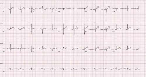 Figure 1. Electrocardiogram showing concave shaped ST- elevation in inferior and lateral leads