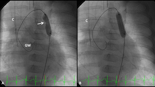 Figure 2 Selected cine angiographic frames in 20° left anterior oblique view showing a balloon dilatation catheter across the aortic coarctation with waisting (arrow) of the balloon (A) during the early phases of balloon inflation which was abolished (B) on further inflation of the balloon. Reproduced from Doshi AR, Rao PS. Coarctation of aorta-management options and decision making. Pediatr Therapeut. 2012;S5:006.Citation47