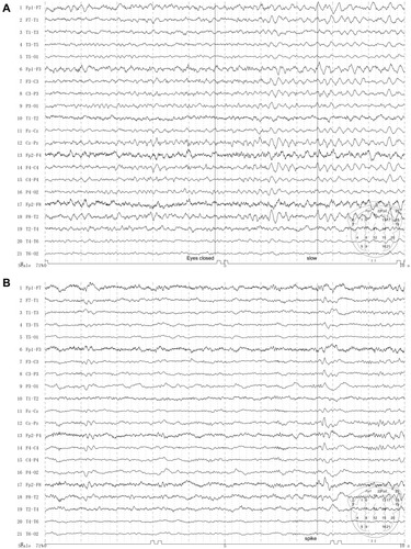 Figure 2 EEG of patient 14. (A) Slow waves during wakefulness. (B) Intermittent discharge.