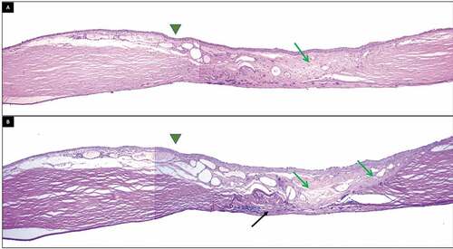 Figure 5. Histopathological images of a section of a corneal button depicting the corneal scar following tenon's patch graft a) Hematoxylin and eosin stain; magnification 40x, b) Periodic acid–Schiff stain; magnification 40x. Stratified epithelial layer continuous with the normal epithelium is seen in the area of the tenon's graft (green arrow heads). Incorporated tenon's layer within the stroma (green arrows) with pseduocornea formation is noted beneath the tenon's layer (black arrow).