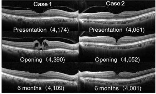 Figure 2 The correlation between changes in SD-OCT and disk-to-fovea distance measurements.