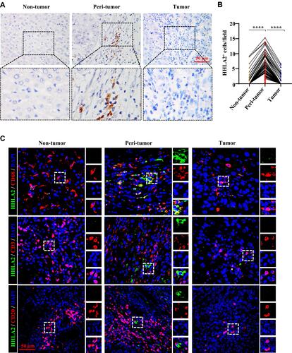 Figure 1 HHLA2 expression in HCC tissues. (A) Representative images of HHLA2 by IHC stating in HCC tissue (scale bar: 50 μm). Arrows indicate representative HHLA2+ cells. (B) Graphs show the number of HHLA2+ cells in different regions of HCC tissue. ****P < 0.0001. (C) Multiplex immunofluorescence staining of HHLA2 with CD68, CD3, or CD20 in HCC tissue (scale bar: 50 μm). HHLA2 staining is shown in green. CD68, CD3 or CD20 staining is shown in red. DAPI staining is shown in blue.