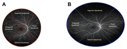 Figure 1 Fluorescein angiogram of the right eye of a patient showing a single-shot, noncontact image centered on the macula. (A) Heidelberg Spectralis® (Heidelberg Engineering, Heidelberg, Germany); (B) Optos® Optomap® (Optos PLC, Dunfermline, UK).