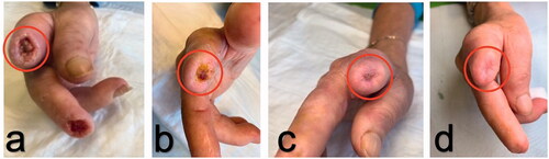 Figure 1. (a–d): Healing process of digital ulcer over stump site (II finger of the right hand) after injection of autologous adipose cells. The circles indicate the site of fat graft as crown-shape infiltration.