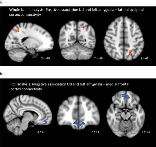 Figure 1. (a) Significant positive association between unresolved loss and trauma and left amygdala–lateral occipital cortex connectivity, resulting from the whole-brain analysis, Threshold Free Cluster Enhancement (TFCE) family-wise corrected, p < .05. (b) Significant negative association between unresolved loss and trauma and left amygdala–medial frontal cortex connectivity, resulting from the region of interest (ROI) analysis, TFCE family-wise corrected, p < .05. The right side of the brain corresponds to the left hemisphere and vice versa.