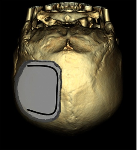 Figure 3 Illustration of the surgical approach depicting craniotomy and ⊃-shaped dural incision. The craniotomy site was approximately 7.5 cm×7.5 cm square. The distance from the medial margin of the craniotomy to the midline was 1.5 cm, and the distance from the lower margin to the transverse sinus was 1 cm.