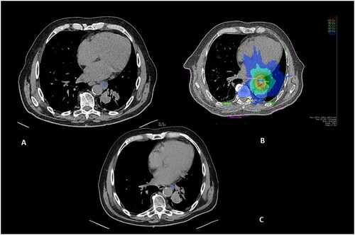 Figure 2. Patient with a clinical history of metastatic NSCLC treated with Nivolumab. A: Oligoprogression consisting of a para-aortic lymphadenopathy detected at follow-up contrast-enhanced chest CT under treatment. B: SBRT delivering 55 Gy in five fractions to the PTV (light blue: 20 Gy; green: 30 Gy; dark green: 40 Gy; yellow: 50 Gy; orange: 60 Gy). C: CT evaluation at six months showing complete response. Patient continued Nivolumab until further polymetastatic progression at 30 months.