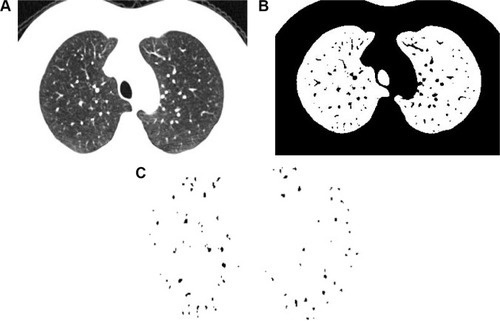 Figure 1 Measurement of cross-sectional area of small pulmonary vessels using ImageJ software in normal subjects.Notes: (A) CT image of lung field segmented within the threshold values from −500 to −1,024 HU. (B) Binary image converted with window level of −720 HU from segmented image. (C) Pulmonary vessels are displayed in black.Abbreviation: CT, computed tomography.