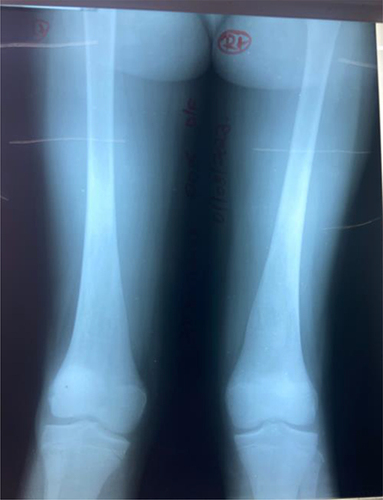 Figure 4 X-ray of the femur taken 5 weeks after splenectomy showing early musculoskeletal changes in the bones (Erlenmeyer flask deformity in the right femur).