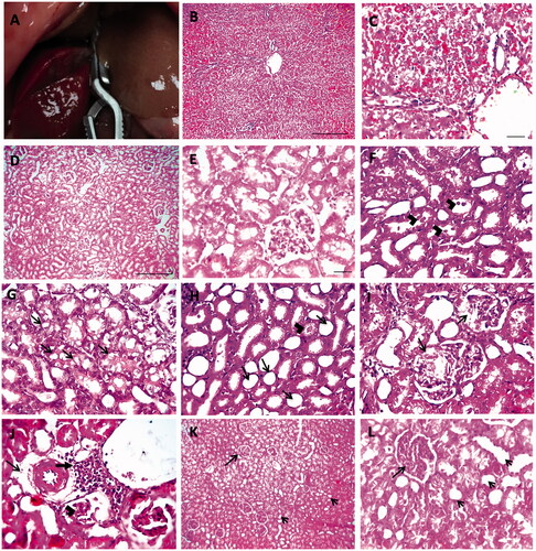 Figure 1. Hepatic ischemia in rat liver (A). Histopathology of liver in hepatic IR group with hematoxylin and eosin (H&E). Low ×100, scale bar = 100 µm (B) and high ×200, scale bar = 50 µm (C) magnification power showed severe sinusoidal congestion and necrosis with hydropic degeneration in hepatocytes. Histopathological pictures of renal tissues stained with H&E from experimental groups (D–L). Kidney showing normal histological picture in sham group (D, E). Kidney sections from IR group showing tubular dilation with presence of hyaline bodies in lumen of tubules (arrowheads) (F), vacuolar degeneration in tubular epithelium (arrows) (G), tubular dilation with loss of brush border (arrows) and tubular cast (arrowhead) (H), swollen Bowman’s capsule with eosinophilic proteinaceous material (arrows) (I), few perivascular edema (thin arrow) with mononuclear cells infiltration (thick arrow) and glomerular shrinkage (arrowheads) (J). Glomerular hypercellularity (long arrow) with loss of brush border from tubular epithelium (short arrows) (K, L) was observed in V + IR group (D, K scale bar = 100 µm, ×100; E scale bar = 50 µm, ×200; F, G, H, I, J scale bar = 50 µm, ×400).