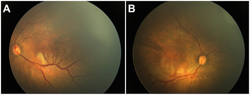 Figure 3 Fundus photography showed incomplete peripheral vascularization and foveal hypoplasia (A) Left eye; (B) right eye).