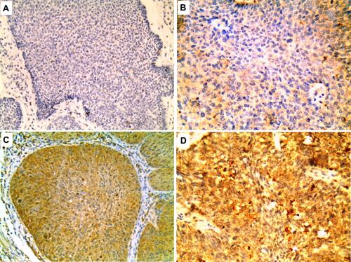 Figure 2 Tumor islands of BCC showing; (A) negative, (B) mild positive, (C) moderate positive and (D) strong positive TROP2 expression (Immunoperoxidase x200 for A and C; x400 for B and D).