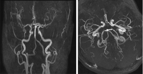 Figure 2. At presentation, magnetic resonance angiogram (MRA) of the circle of Willis showed no abnormality.