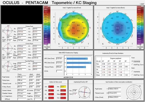 Figure 3 Topometric map of the same patient 1 year after CXL. It shows improvements in Kmax and keratoconus indices with decreased corneal thickness.