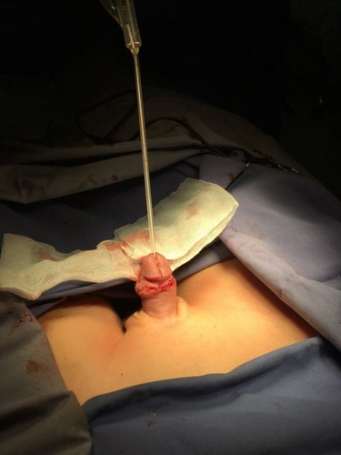 Figure 6 Traction disappeared and the dorsal chordee corrected after excision of the accessory urethra.