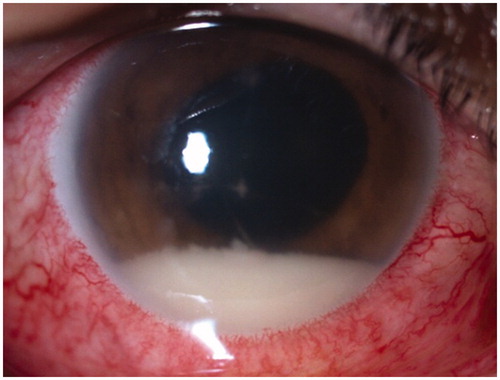 Figure 1. Anterior segment photography of the patient at presentation, showing injected conjunctiva and hypopyon.