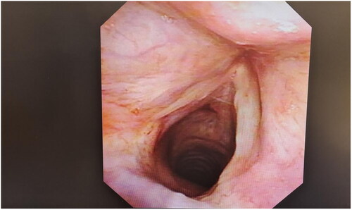 Figure 2. Post-treatment condition of the vocal cord polyp.