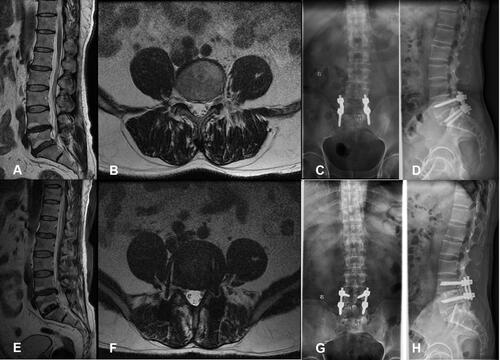 Figure 2 Type case: Male, 49 y, with L5/S1 lumbar disc herniation, degeneration of the L4/5 intervertebral disc before the operation, and Pfirrmann grade IV (A and B). Transforaminal lumbar interbody fusion (C and D) was performed on lumbar 5/sacral 1 in February 2013, which significantly relieved his symptoms. In January 2018, the patient developed numbness and pain in the left lower extremity. Lumbar intervertebral disc MRI showed that the L4/5 disc was herniated and compress the left nerve root (E and F). He was diagnosed with adjacent segment disease. L4/5 was treated by transforaminal lumbar interbody fusion (G and H), which significantly relieved the symptoms.