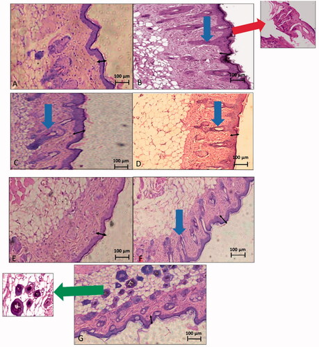Figure 11. Histopathological images of skin samples of different groups. (A) Negative control, (B) positive control, (C) group A, treated with the marketed product, (D) group B, treated with C nanoparticles, (E) group C, treated with L nanoparticles, (F) group D, treated with G1 nanoparticles, and (G) group E, treated with G2 nanoparticles. Black arrow: epidermal skin thickness. Red arrows: parakeratosis. Blue arrows: acanthosis. Green arrow: gold nanoparticles deposition around hair follicles.