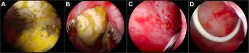 Figure 6 The stone was fragmented with shock-pulse lithotriptor (A) and taken out with stone forceps (B). There was no residual stone after the procedure (C). A 6-Fr DJ stent was inserted retrogradely (D).