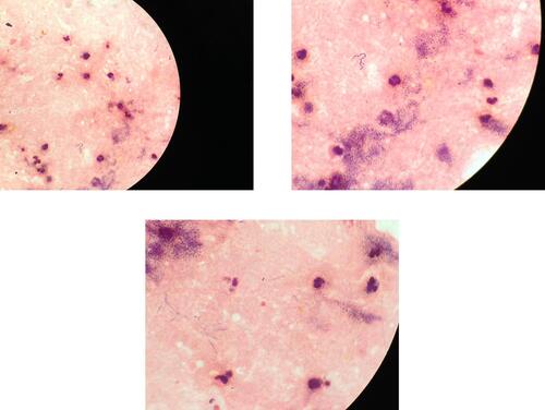 Figure 2 Left calf centesis. Disseminated Nocardia nova. Left calf centesis, 30 cc of pus. Direct examination with numerous polymorphonuclear neutrophils and aggregated gram positive rods and delicate, beaded, branching filaments. The Nocardia nova was found to be resistant to amoxicillin and clavulanate, tobramycin, ciprofloxacin and moxifloxacin.