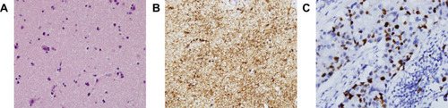 Figure 4 Postoperative pathological results of the initial intracranial space-occupying lesion. Haematoxylin–eosin (H&E) staining of biopsy samples (40×) magnification. (A) Postoperative immunohistochemical staining results of the initial intracranial space-occupying lesion showed GFAP 3+ (B), Ki-67 <5% (C).