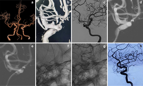 Figure 4 A 51-year-old woman with a BBA arising from the dorsal wall of the ophthalmic segment of the left ICA. (a–c) The CTA at admission and the preprocedural DSA image showed that a BBA was located at the C6 segment of the left ICA. (d and e) The WCS was transferred to bridge the aneurysm orifice on the basis of the roadmap. (f and g) The WCS was successfully deployed. (h) Cerebral angiogram immediately after stent deployment showed complete occlusion of the aneurysm orifice with intact preservation of OA and PcomA.