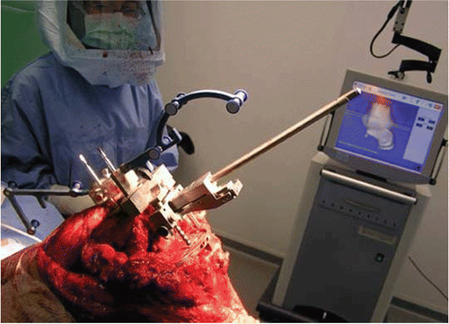 Figure 6. Preoperative view showing the navigation of the distal femoral cut, with the cutting guide mounted on an intra-medullary jig. In the present system, two femoral angles were proposed (5° and 7°). If one of these angles was adequate, canal-filling femoral stems could be used; if neither of them was adequate, a thinner stem was used, allowing some degree of tilting until the correct angle was obtained. [Color version available online.]