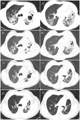 Figure 1 Comparison of cross-sectional chest CT scan images of the patient with MDR-TB at different time points before and after taking effective treatment regimens. (A) Three months before effective treatment regimens showing multiple lesions and cavities in bilateral lungs (black and white arrowheads) at two cross-sections (A1 and A2); (B) Two months after effective treatment regimens showing absorption of multiple lesions and cavities in bilateral lungs (black and white arrowheads) at two cross-sections (B1 and B2); (C) Eight months after effective treatment regimens showing multiple lesions and cavities in bilateral lungs disappeared (more obvious in the right lung), and fibrosis remained unchanged (black and white arrowheads) at two cross-sections (C1 and C2); and (D) Seven months after the 20-month treatment using effective regimens showing multiple lesions and cavities in bilateral lungs disappeared (more obvious in the right lung) and pulmonary fibrosis remained unchanged (black and white arrowheads) at two cross-sections (D1 and D2). CT, computed tomography; MDR-TB, multidrug-resistant tuberculosis.