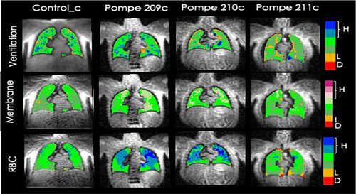 Figure 3 Comparative Panels of 129Xe Ventilation, Membrane Uptake, and Red Blood Cell (RBC) Transfer in Control and Pompe Disease Patients.