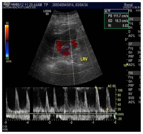 Figure 4 Color Doppler revealed selective low renal blood of lower pole of left kidney.