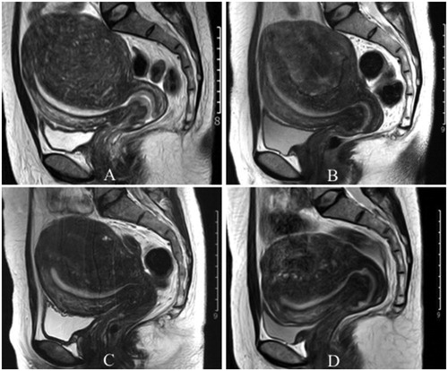 Figure 4. Change in lesion volume before PMWA and at follow-up on MRI. A: Lesion size before PMWA (A), 1 month (B), 6 months (C) and 12 months (D) after PMWA.