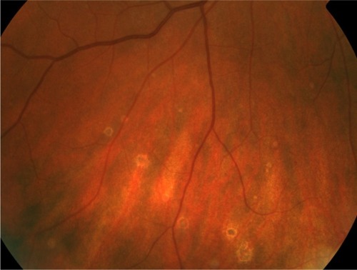 Figure 2 Color fundus photograph of the right eye demonstrating well circumscribed chorioretinal lesions with hyperpigmentation.