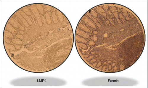 Figure 2. Illustrative case of LMP1 and Fascin expression in an intermediate grade invasive CRC sample. Magnification value is 40X. We note that the left zone of the sample is normal tissue which is negative for both LMP1 and Fascin; however, the lower-right zone shows cancer cells that are positive for LMP1 and Fascin.