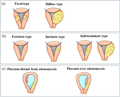 Figure 1. Schematic representation of the classification of adenomyosis based on imaging findings. (a) Extent of lesions: the lesion >25% of the circumference was surrounded by normal myometrium was defined as the “focal type”; whereas that <25% was surrounded by normal myometrium was classified as the “diffuse type”. Circumference of the lesion surrounded by the normal myometrium, as is illustrated indicated by the red line. (b) Location of the lesion: The lesion was classified as the “extrinsic type” if it presents on the serosal side of the uterus, and as “intrinsic type” if it presents in the uterine inner layer. “Indeterminate type” includes lesions extending through all layers of uterine muscle and multiple lesions. (c) Positional relationship between the lesion and the placenta: the lesion was classified as “placenta distant from adenomyosis” when the adenomyosis lesion was not present in the myometrium which was in contact with the placenta, whereas it was classified as “placenta over adenomyosis” when the adenomyosis lesion was included in the myometrium in contact with the placenta.
